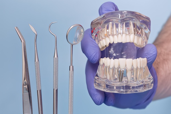 The Longevity Of Implant Supported Dentures
